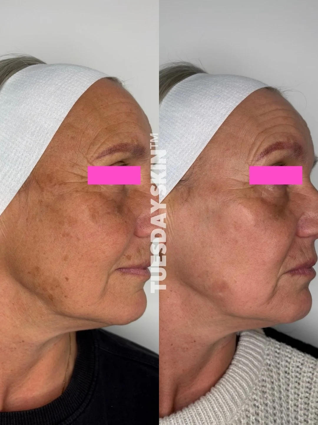 &ldquo;I&rsquo;d never been big on skin treatments, skincare or even SPF. I thought my skin was far too sensitive and that products were mostly smoke and mirrors. Turns out, I just needed to visit my niece at Tuesday Skin.  I&rsquo;m genuinely shocke