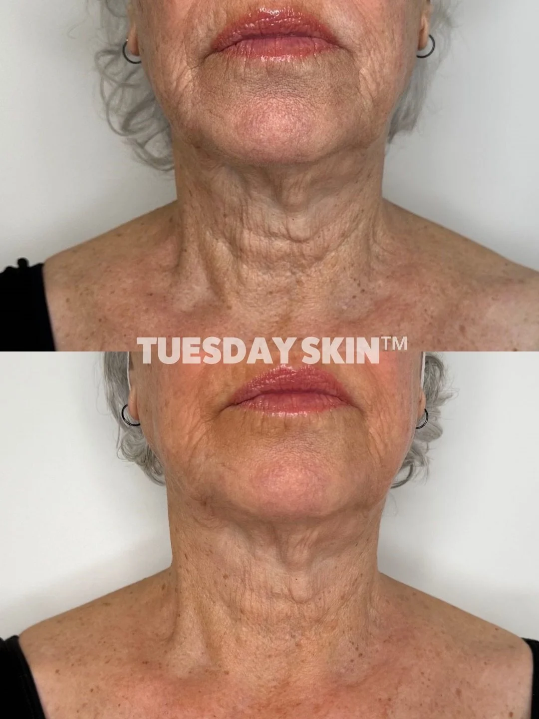 This is 1 month post a weekly SkinTyte series for lower face &amp; neck for this gorgeous client who we&rsquo;ve been working closely with to tighten our SkinTyte protocol and see how much change we could achieve.

These photos are just ONE MONTH apa