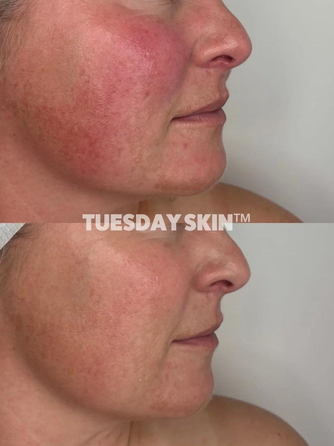 There is only seven weeks and 1 x BBL/MOXI Stack between these pics⚡️ The redness is calm, skin tone is more even, healthy and glowing but most importantly this baddie is incredibly happy with her results.

BBL/MOXI Stack by @misscasscarter