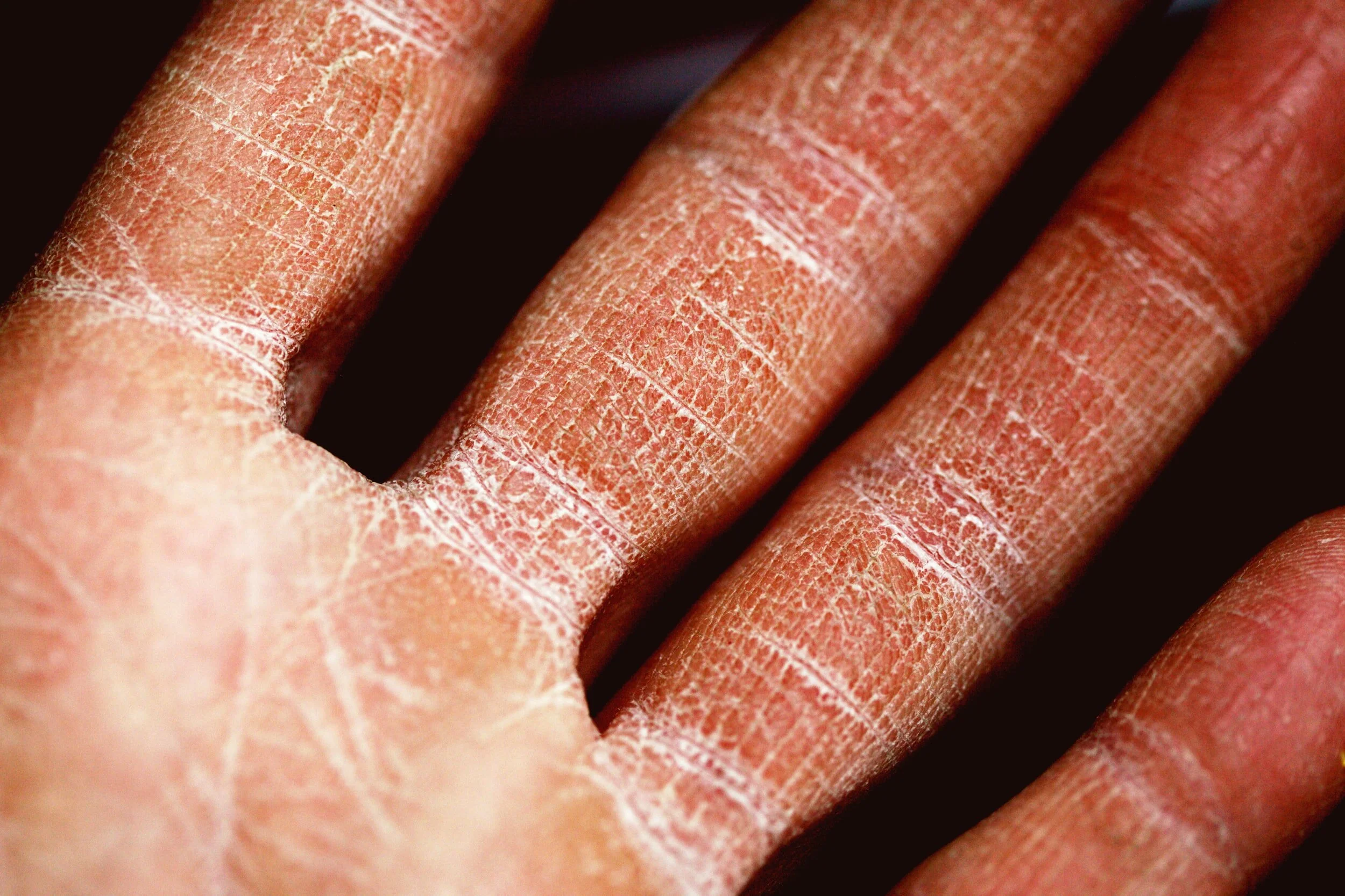 More Than Just Dry Skin Charlotte Dermatology P A 