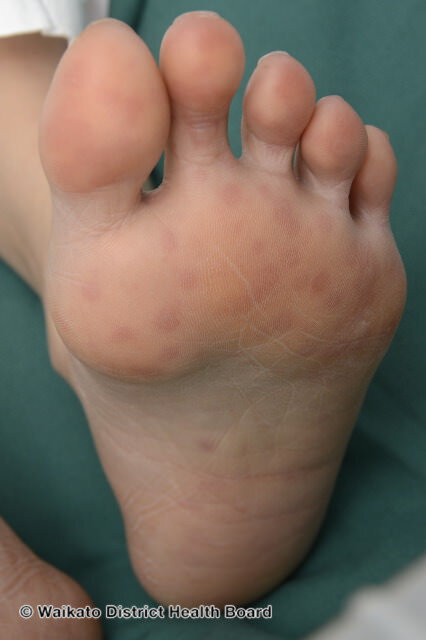 Hand Foot And Mouth Disease — Charlotte Dermatology P A