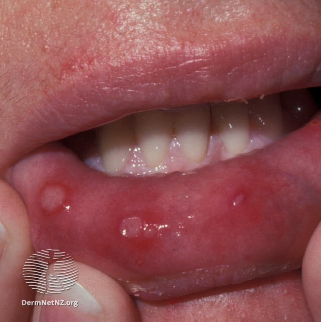 Hand Foot And Mouth Disease — Charlotte Dermatology P A