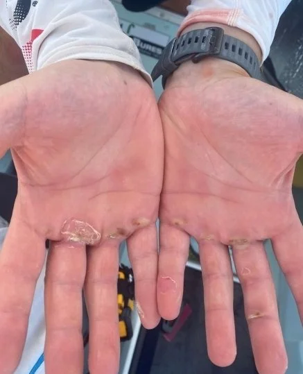 Blisters from rowing.jpeg