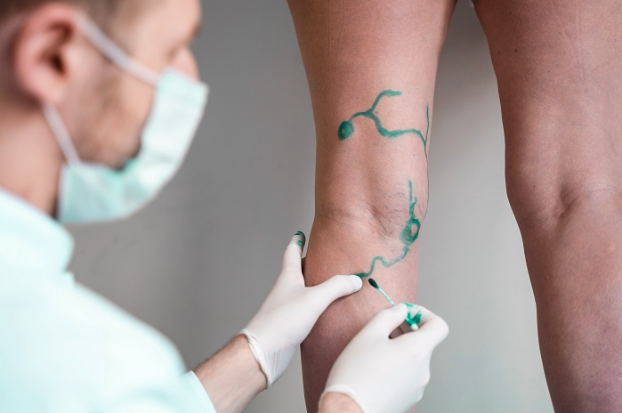 O que faz um cirurgião vascular?