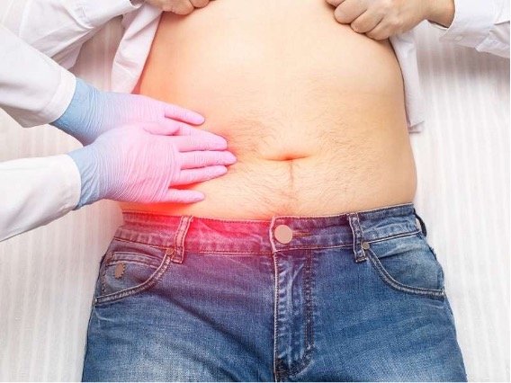 Aneurisma da Aorta Abdominal - o que é, causas e fatores de risco