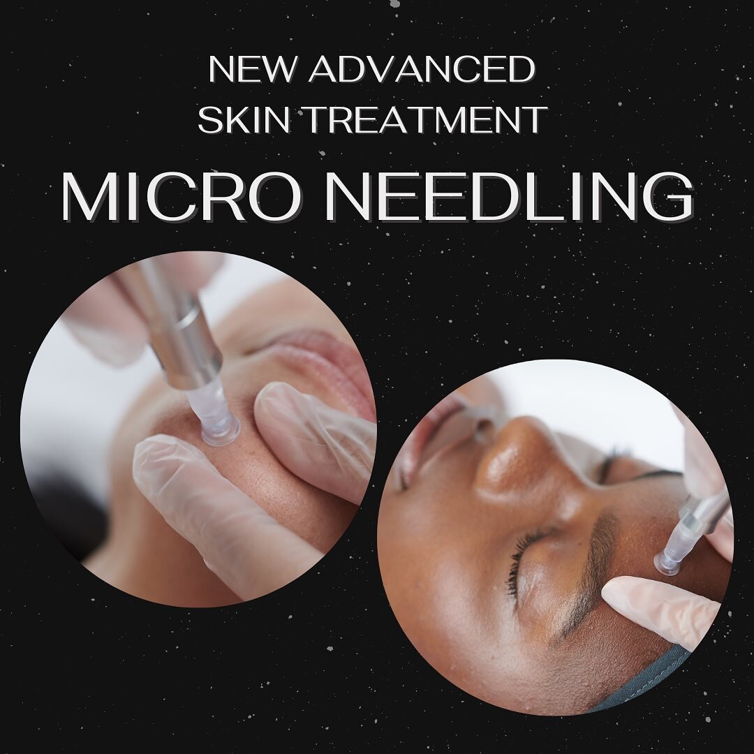 We are super excited to be launching our new advanced skin treatment, Micro Needling! ✨ 

Needling triggers production of collagen and elastin, rebuilding the skin's dermal structure and helping to reduce the appearance of fine lines, wrinkles and te