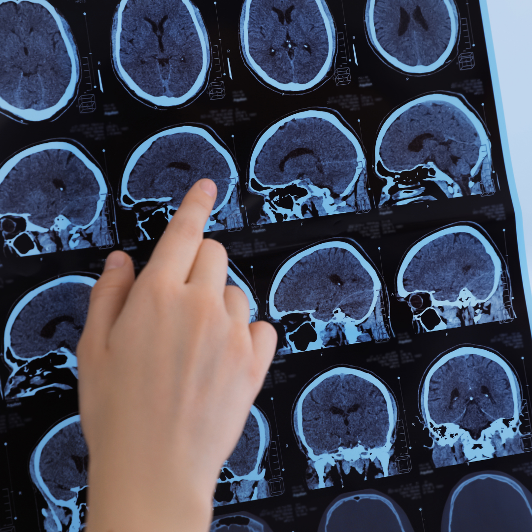 From Headaches to Memory Loss: The Widespread Effects of Concussions