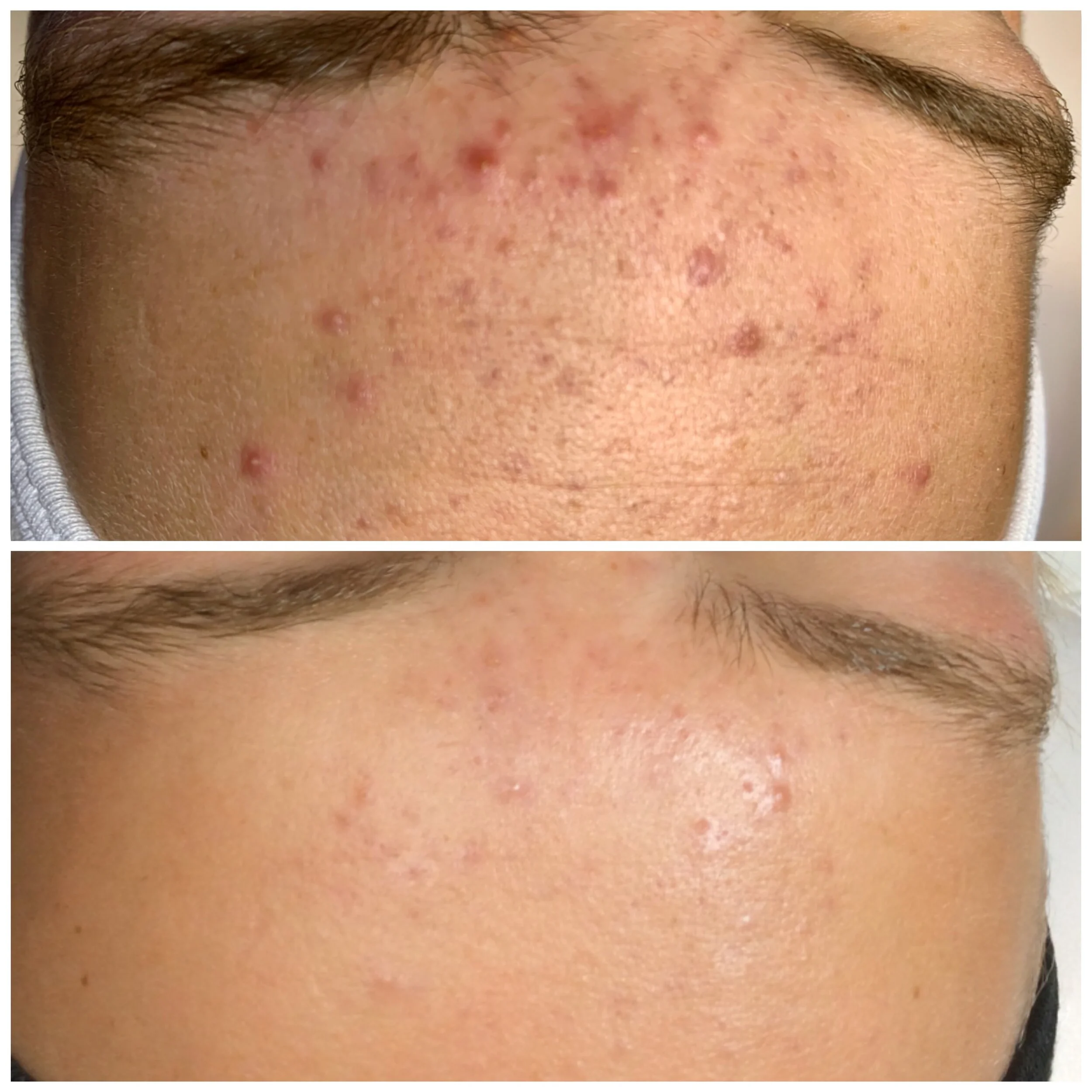 BEFORE and AFTER hydrafacial + clarity peel .jpg