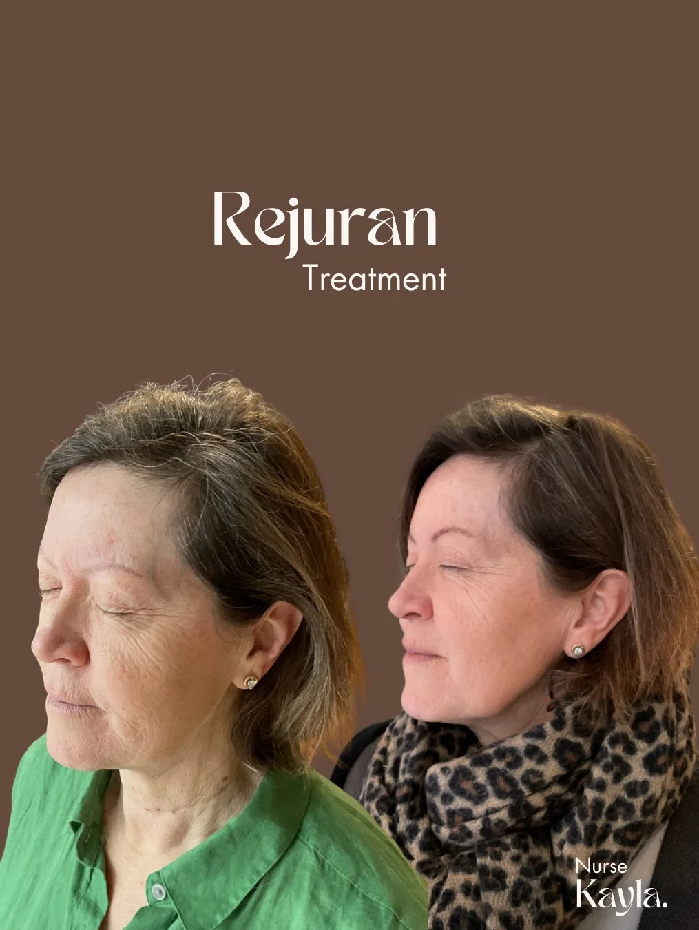 Rejuran (1015 x 1350 px) - 8.jpeg
