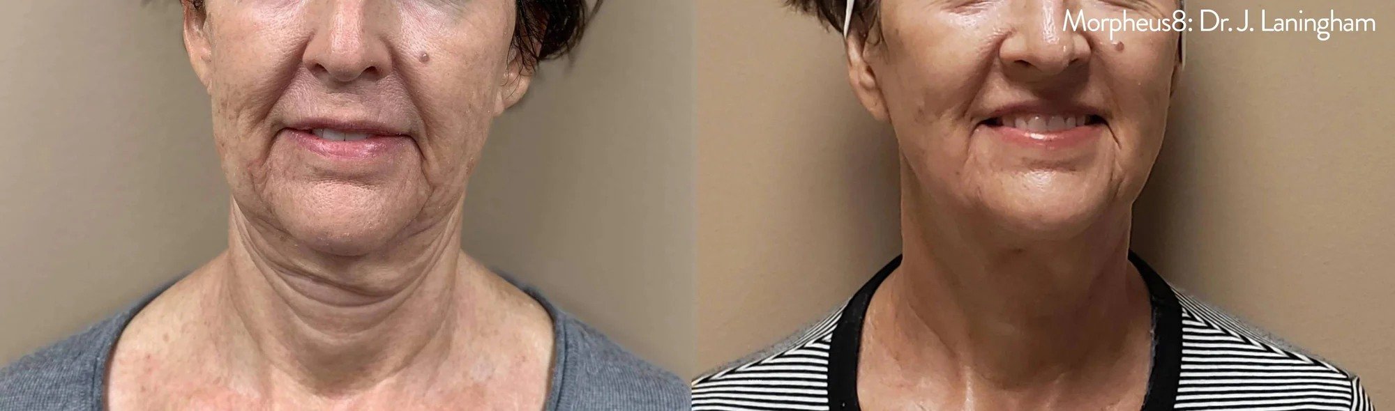 Morpheus8_Neck_Front_JLaningham_2000x.jpg