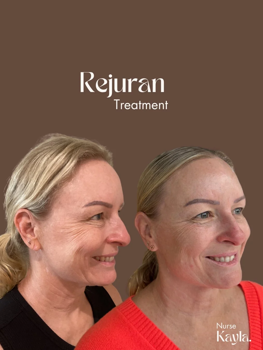 Rejuran (1015 x 1350 px) - 5.jpeg