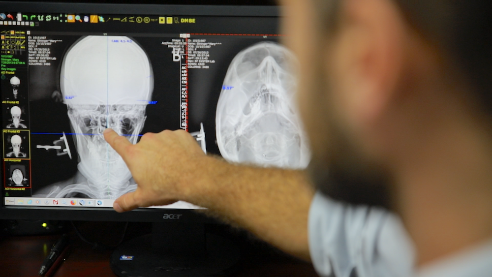 Upper Cervical X-Rays.png