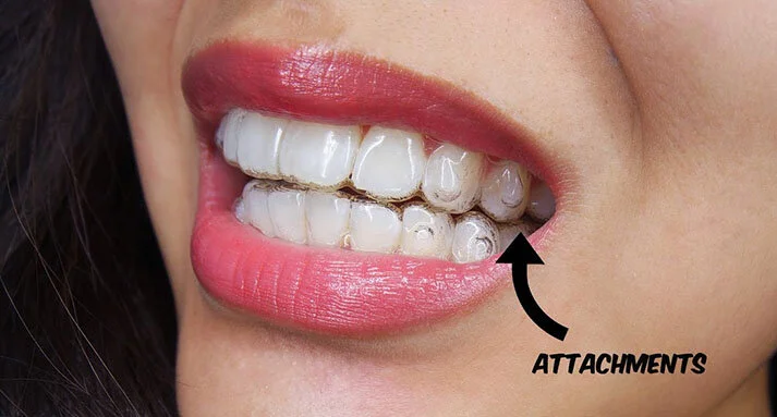 Life Invisalign — Day Orthodontics | Maria, CA