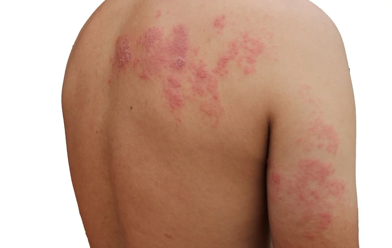 Shingles Prevention — Mosman Park Family Practice