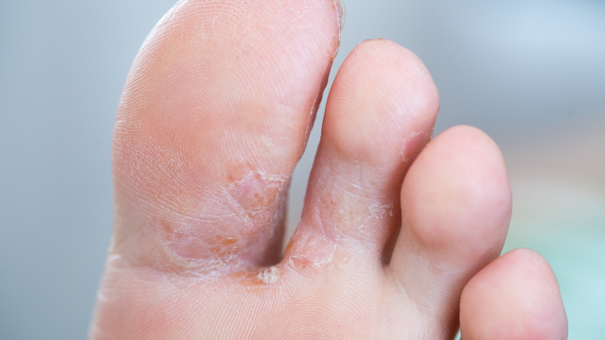 Athletes Foot Treatment In Shepshed — Focus On Feet Foot Care In Shepshed