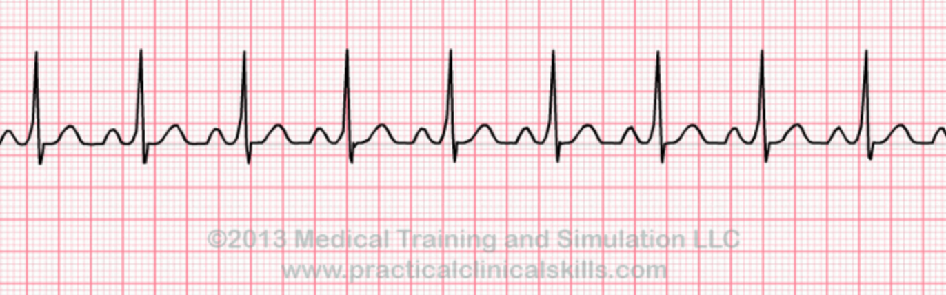 Wolff-Parkinson-Whaaaat?