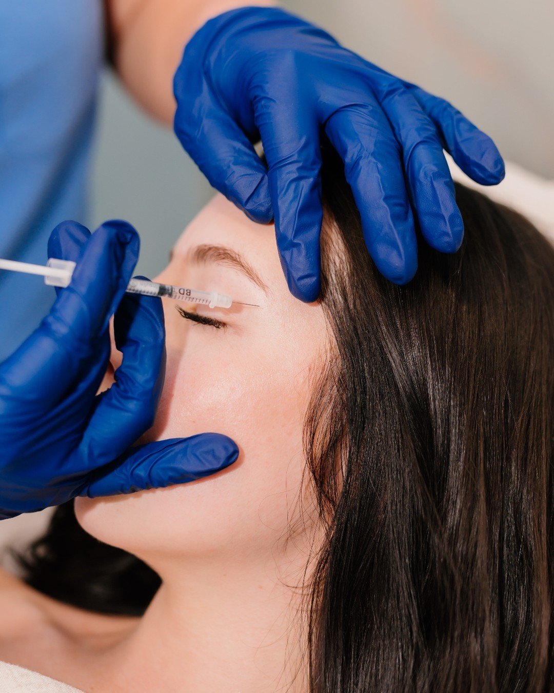 💉 Think Botox is just for those with visible fine lines? Think again! Botox isn't just about reversing signs of aging &ndash; it's also a preventative powerhouse. Ideal for both those with moderate to severe fine lines and the younger crowd looking 