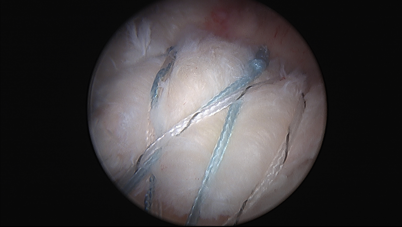 The Effect of Patient Characteristics and Comorbidities on the Rate of Revision Rotator Cuff Repair