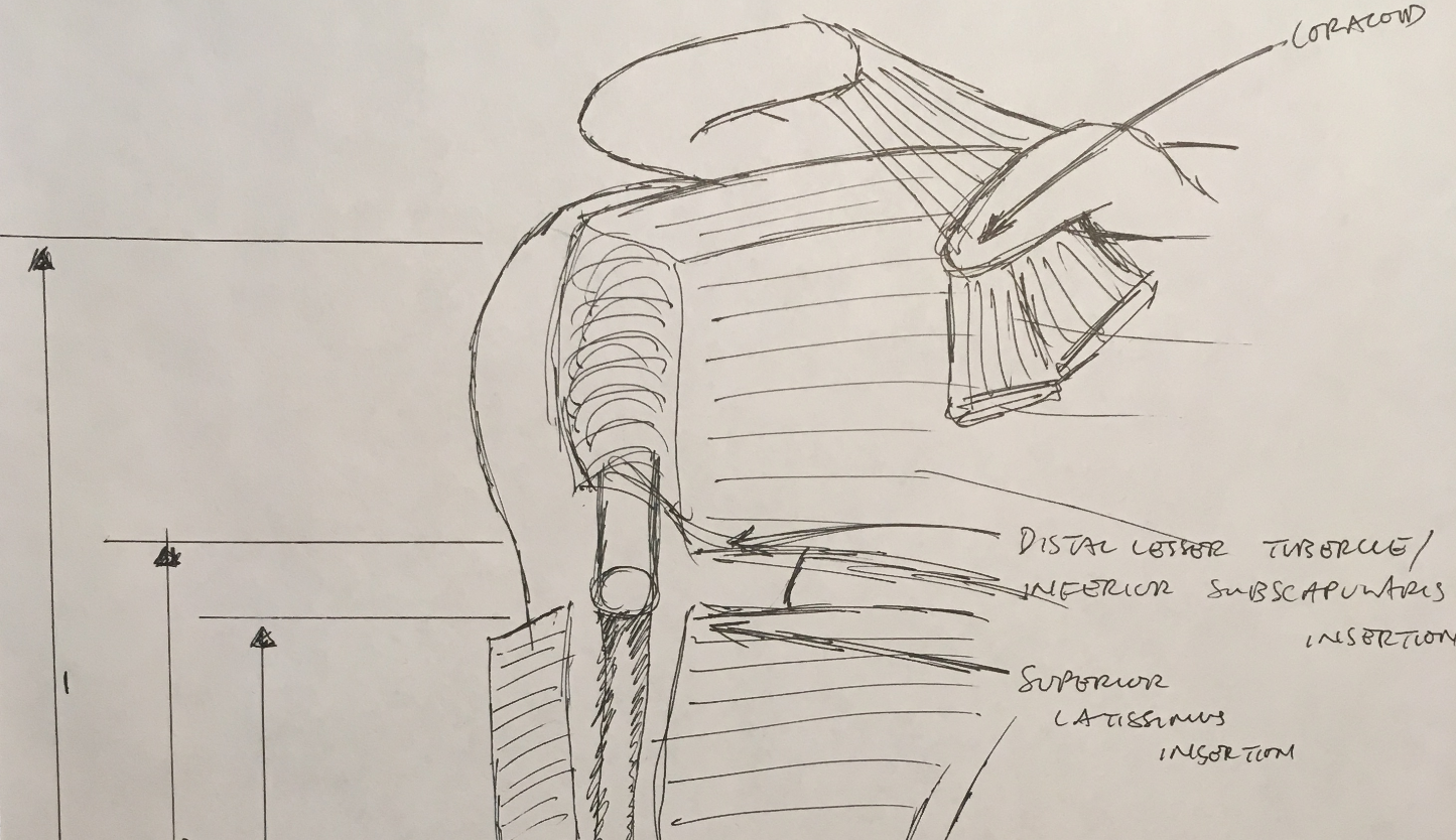 Surgical Anatomy of the Radial Nerve in the Deltopectoral Approach for Revision Shoulder Arthroplasty and Periprosthetic Fracture Fixation: A Cadaveric Study
