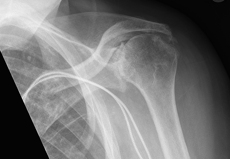 Cuff Tear Arthropathy — Michael Fu, MD - HSS Shoulder Surgery