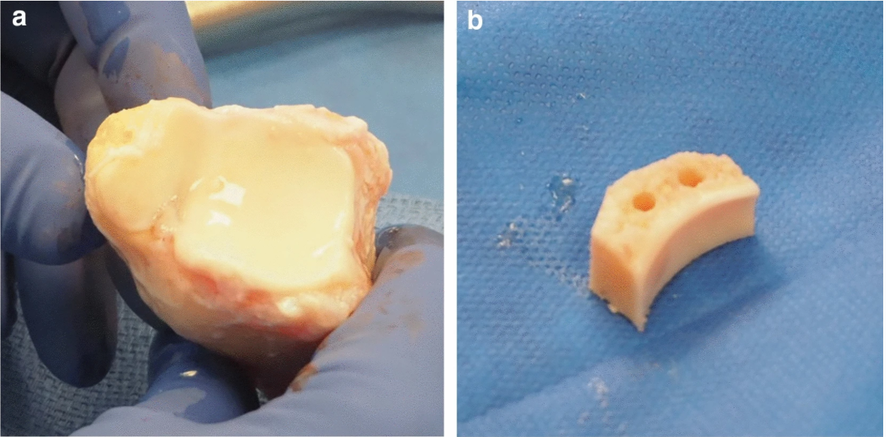 Outcomes are Comparable Using Free Bone Block Autografts Versus Allografts for the Management of Anterior Shoulder Instability with Glenoid Bone Loss: A Systematic Review and Meta-Analysis