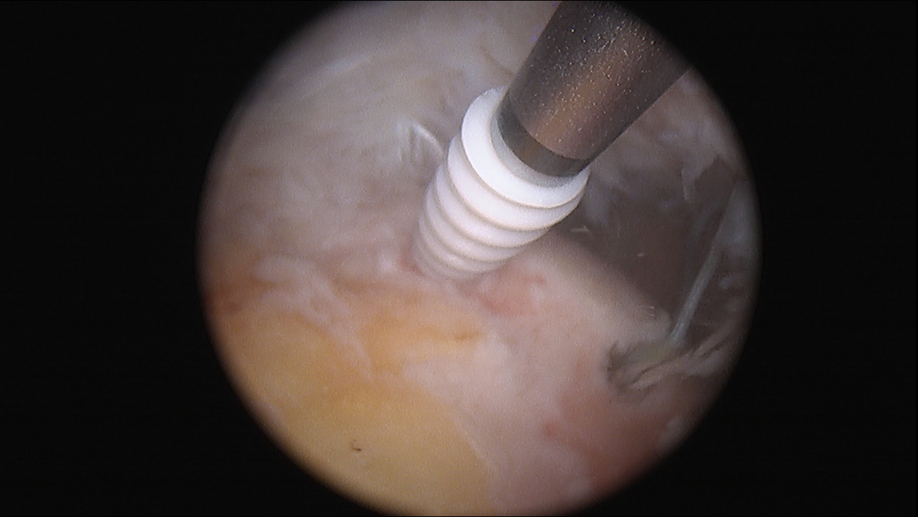 Risk Factors for Short-Term Complications After Rotator Cuff Repair in the United States
