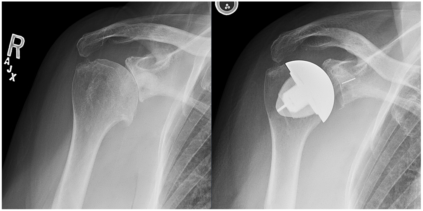Shoulder Replacement at HSS — Michael Fu, MD HSS Shoulder Surgery