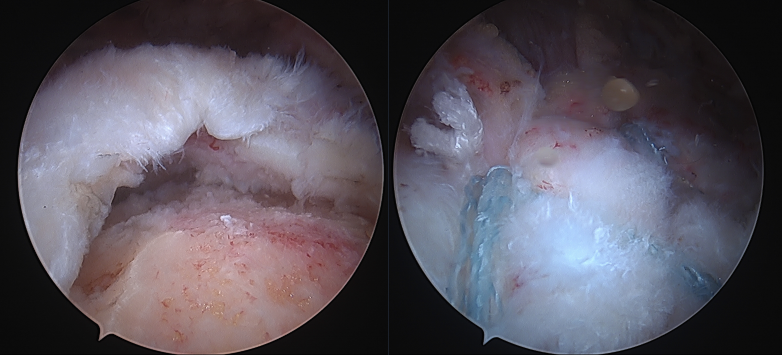 Establishing the Minimal Clinically Important Difference, Patient Acceptable Symptomatic State, and Substantial Clinical Benefit of the PROMIS Upper Extremity Questionnaire After Rotator Cuff Repair