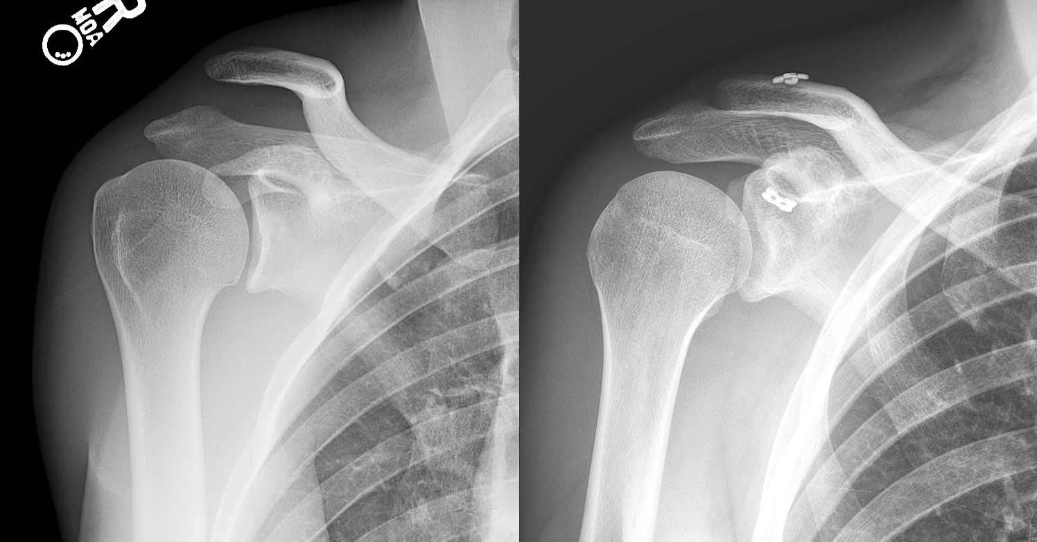 AC Joint Injury Shoulder Separation — Michael Fu, MD - HSS Shoulder Surgery