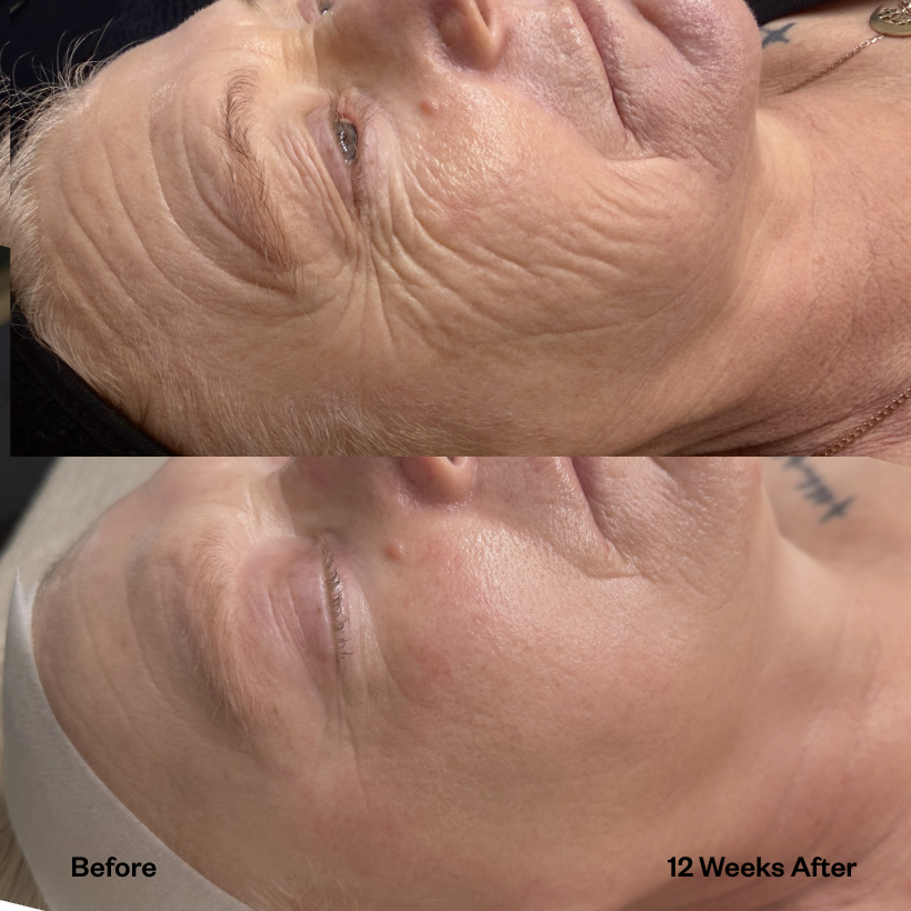 Does Plasma Fibroblast Really Tighten Skin? An Honest Guide
