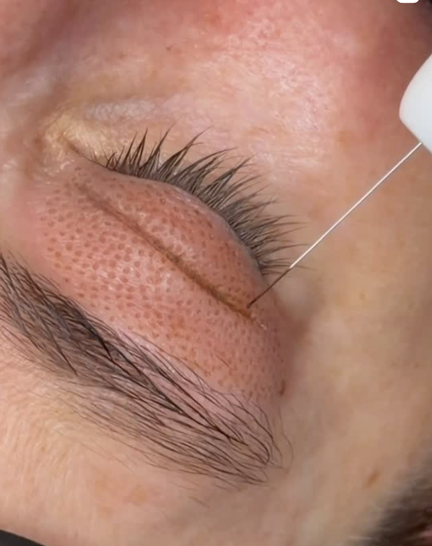 Non-Surgical Eye Lift Melbourne: Plasma Fibroblast vs Blepharoplasty