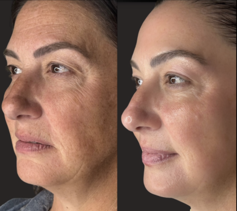 How Long Do Plasma Fibroblast Results Last? An Honest Guide