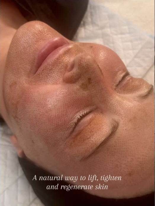 PPlasma Pen skin tightening treatment at HITECH SKIN Armadale Melbourne