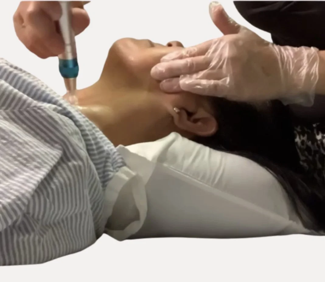 Radiant Holiday Skin: Unleash the Power of Micro-Needling Collagen Induction Therapy!