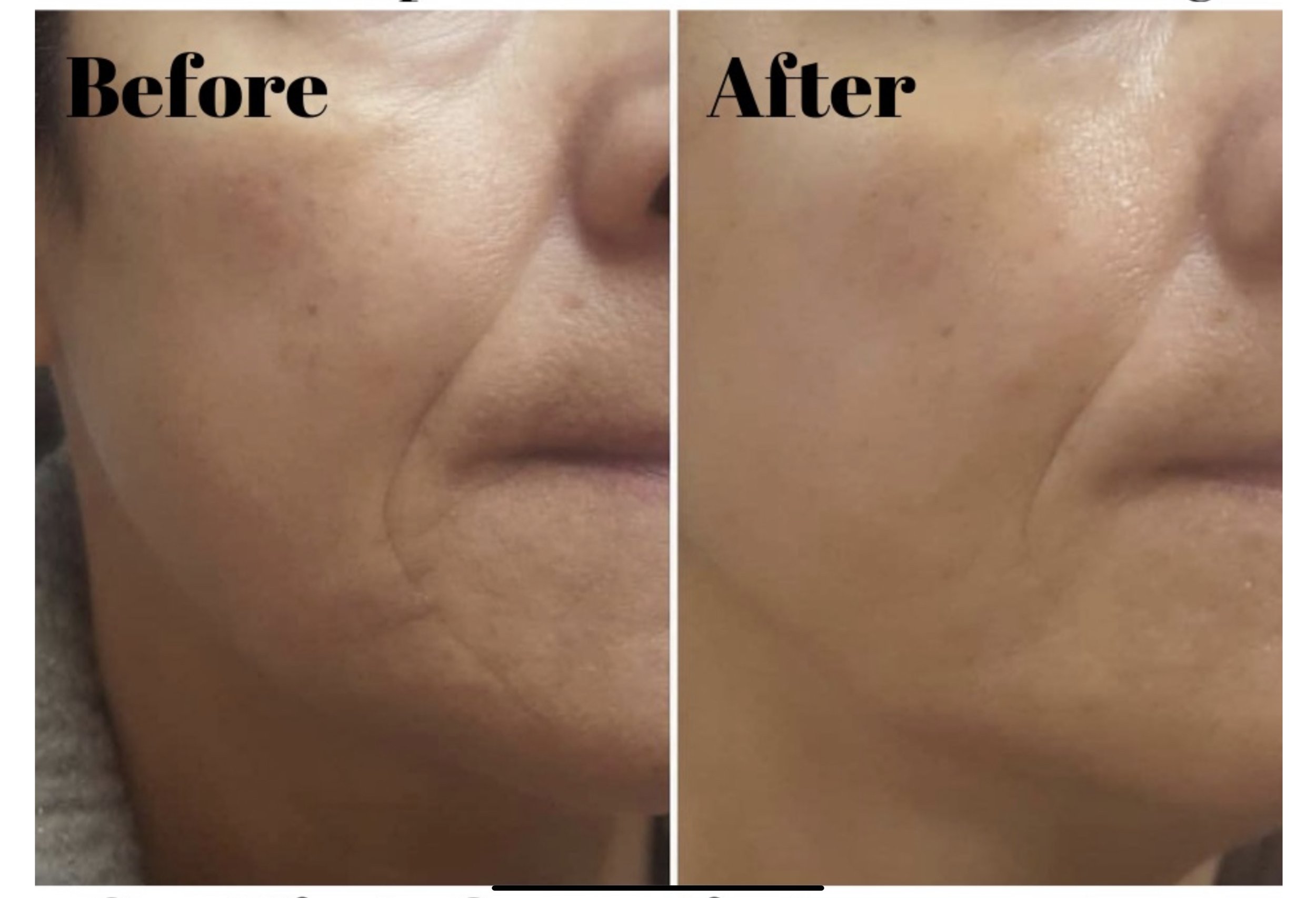 before-and-after medical microneedling showing reduced wrinkles and firmer lower-face skin.