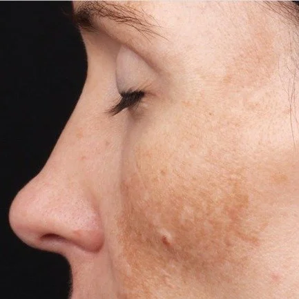 Real results, real skin ✨

This is what consistent skincare with Nimue Skin Technology can do &mdash; visible improvement in pigmentation, tone and overall skin clarity.

Ready to start your own transformation? Book a consultation with our therapists