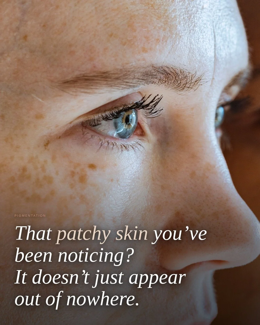 That patchy skin you've been noticing? It doesn't just appear out of nowhere.

Sun damage, hormonal changes, and years of UV exposure all contribute to pigmentation becoming more visible in your 30s and 40s. The good news &mdash; it's treatable, and 