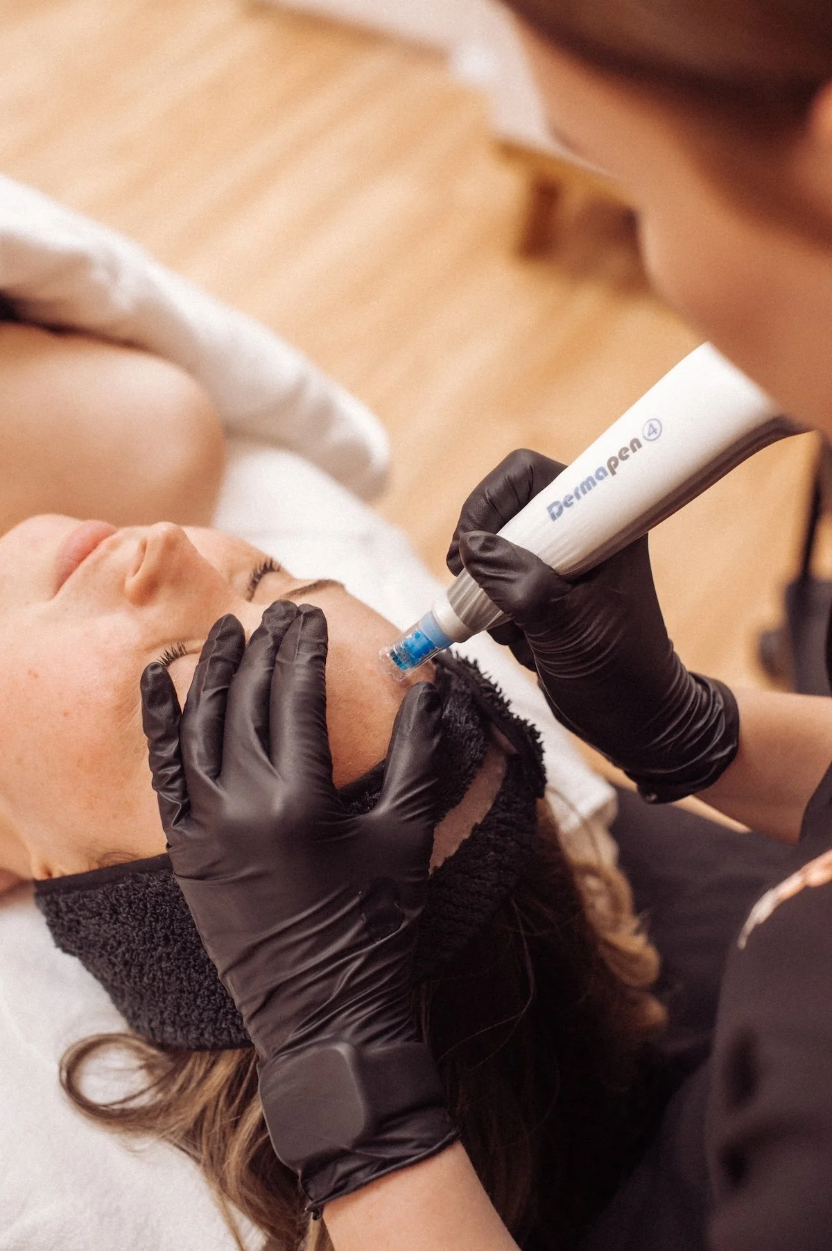 Client having a microneedling treatment known as collagen induction using a Dermapen needling device
