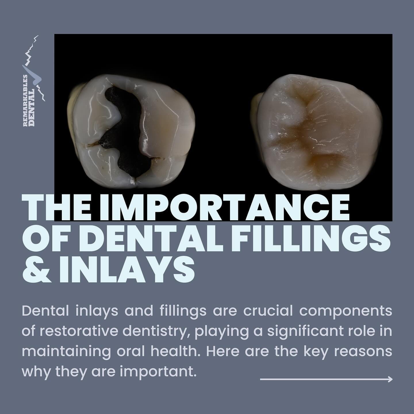 Dental inlays and fillings are vital for preserving tooth function, preventing further decay, enhancing aesthetics, providing structural support, and maintaining overall oral health. By addressing dental issues promptly with these restorative techniq