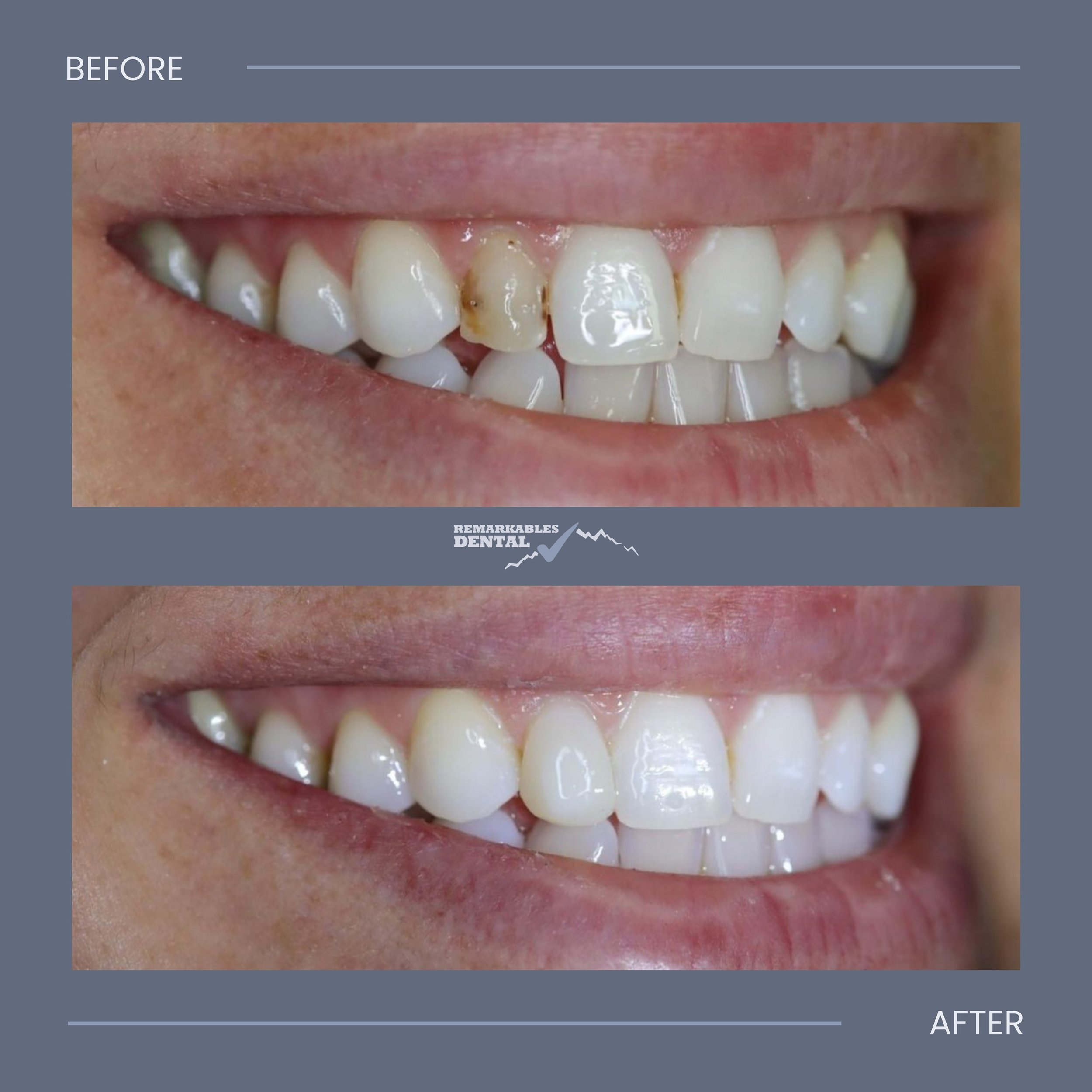 A single composite veneer making such a difference 👏🏼 a same day smile make-over by @teethbytony 🦷

#dentalmakeover #cosmeticdentistry #queenstown #frankton #nz #dentistry