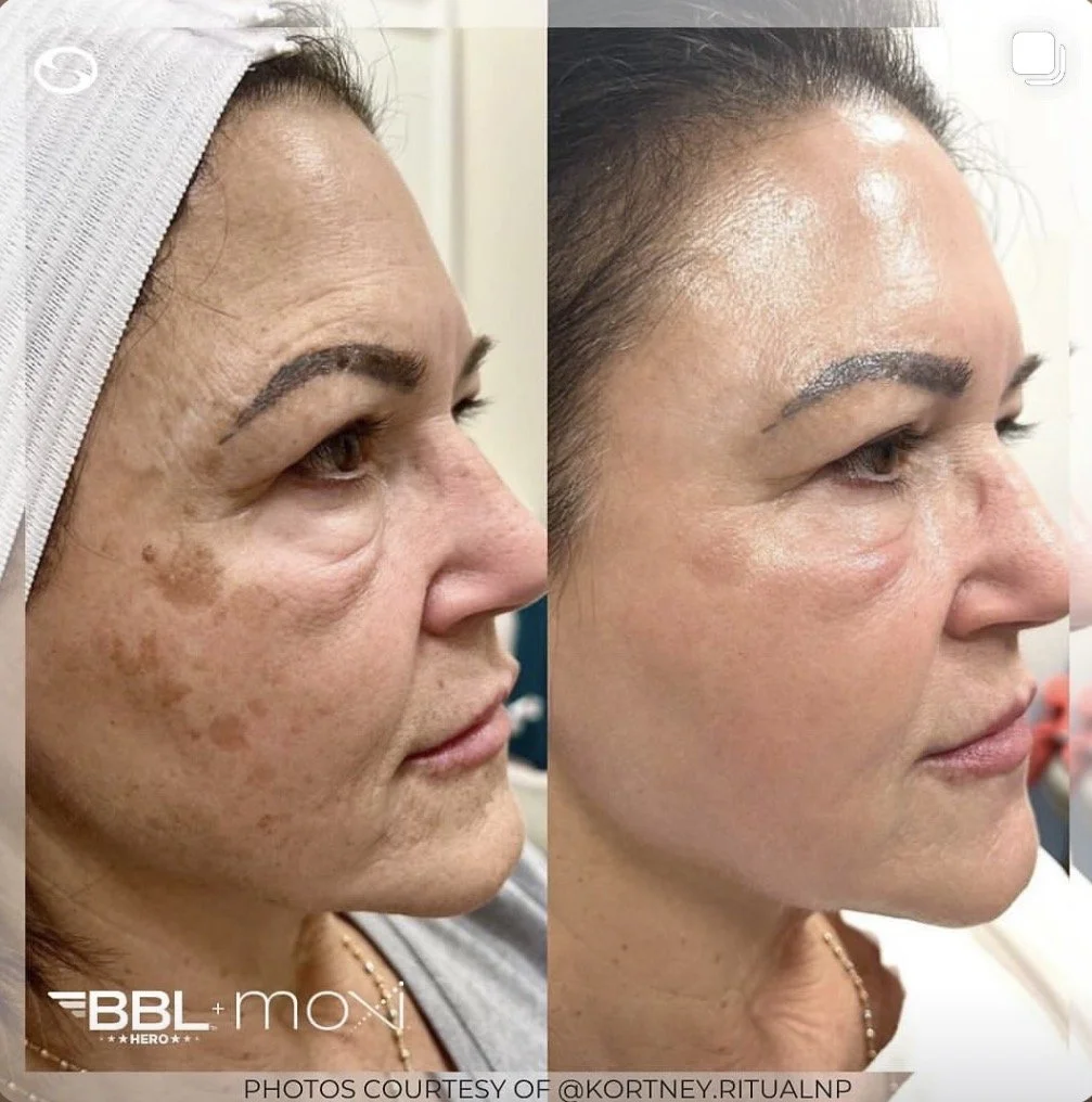 BBL, Moxi or BBL + Moxi: What’s the Difference and Which Do You Need?