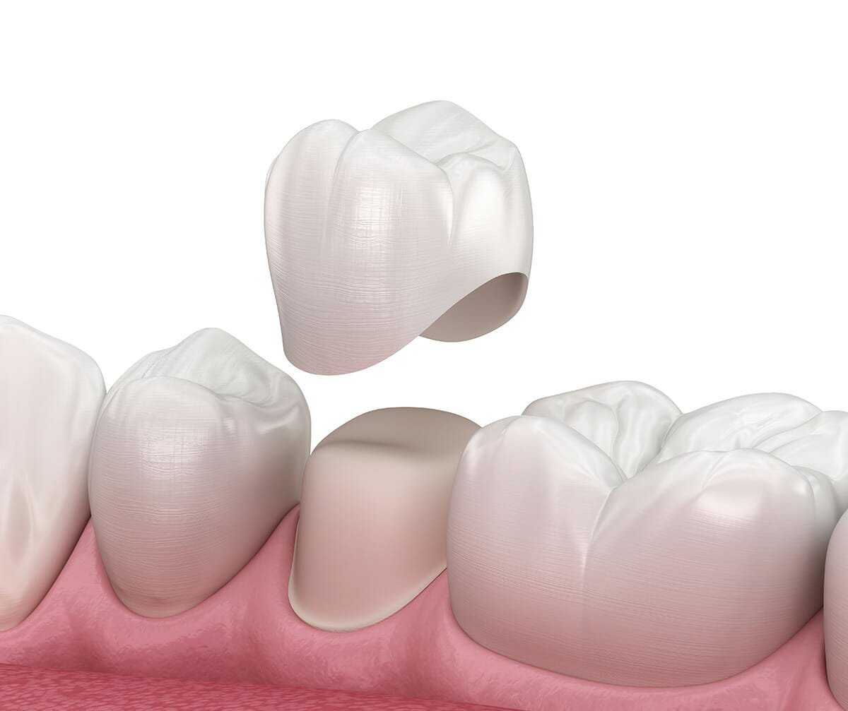 Partial Coverage or Full Coverage: What Is Best for Your Tooth? — Herbert  S. Birnbaum, DMD