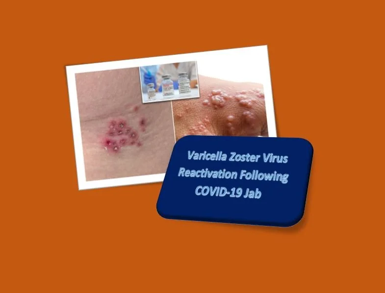 Varicella Zoster Virus Reactivation Following COVID-19 Jab 