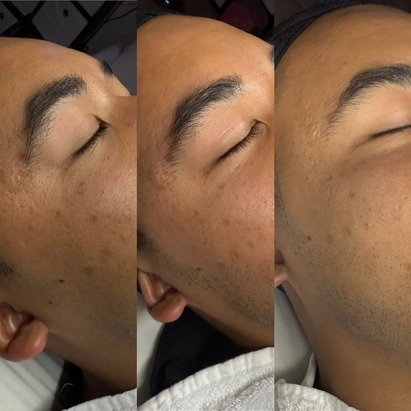 Before &gt; right after the 2nd peel &gt; right after the 3rd peel 

Wasn&rsquo;t able to get a final results pic of the BioRePeel series of 4! But, in just 3 sessions, we achieved smoother skin texture, pore size &amp; scaring reduced, improved glow