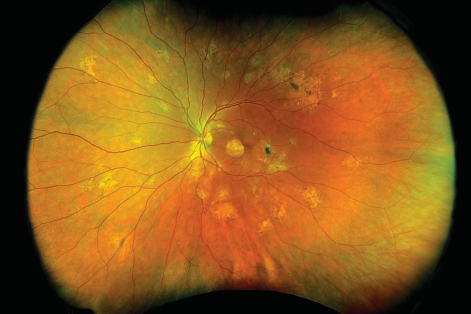 Retinal scan showing signs of age-related macular degeneration, with yellow deposits and abnormal blood vessels.