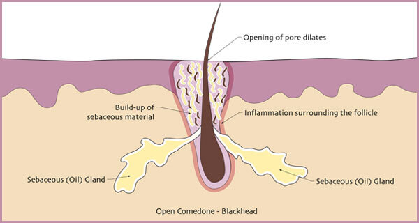 open-comedone4.jpg