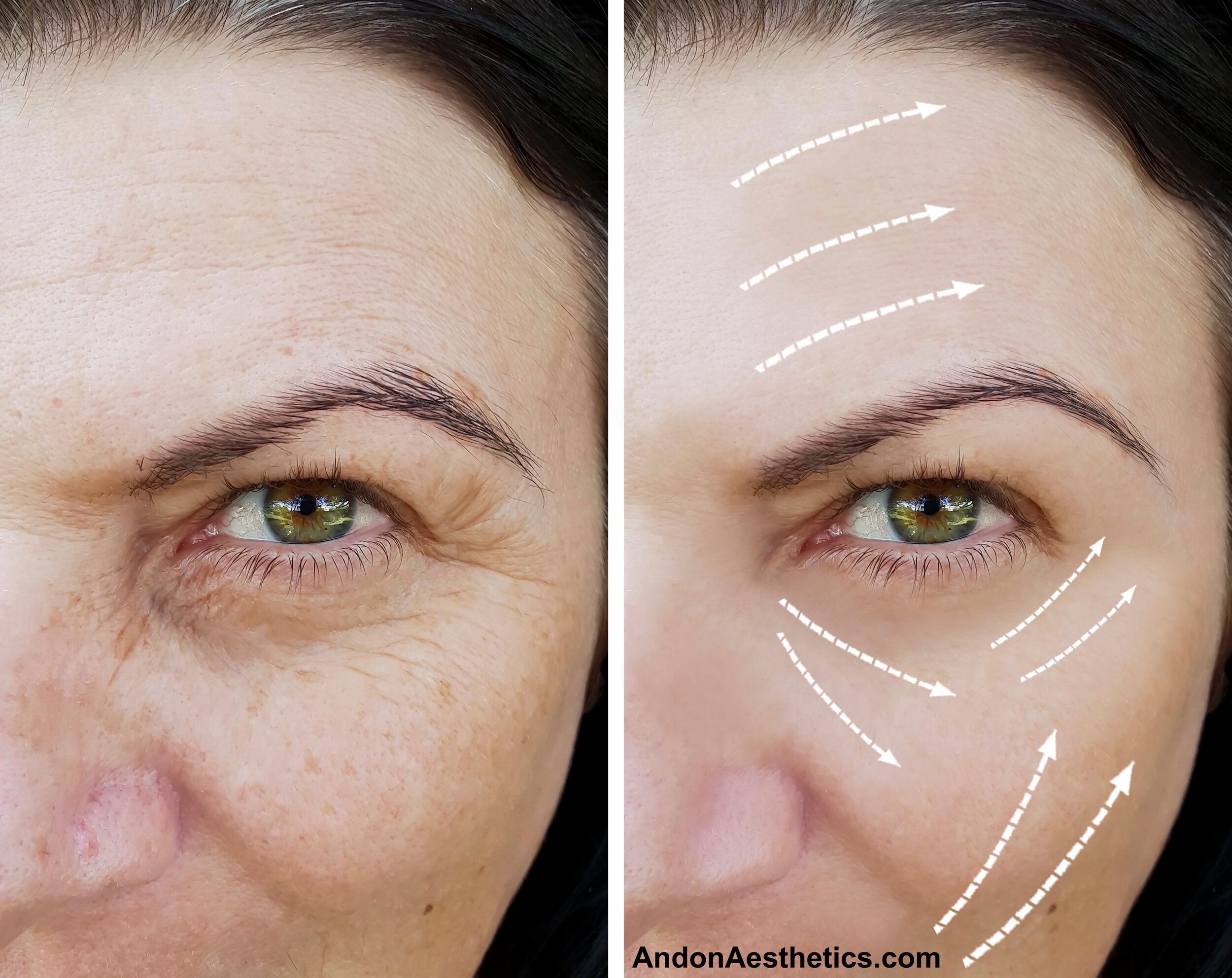 Dermal Fillers for Dark Circles Under Eyes  Clinetix