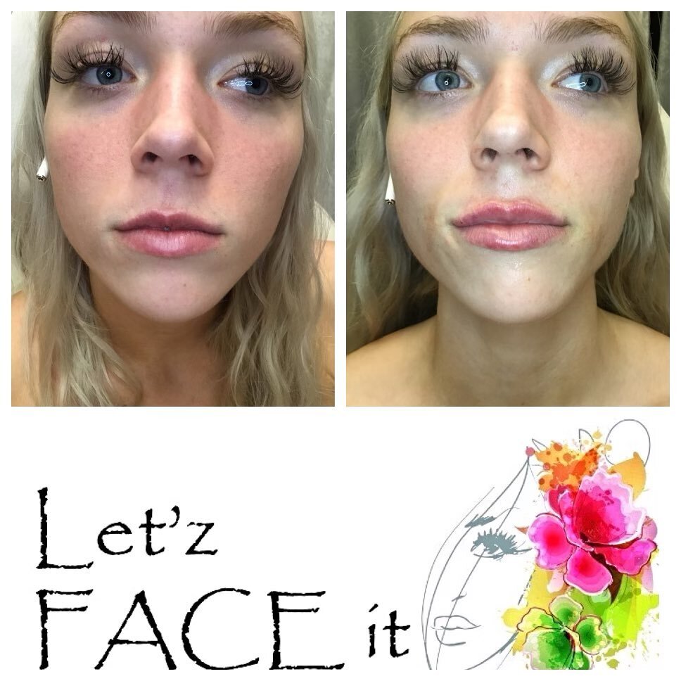 Thankful hearts and full lips 👄 

Limited Appointments available before Thanksgiving! Grab while you can 🌺 
.
.
💃 procedure: non-surgically enhancement with hyaluronic acid gel to increase volume &amp; correction of asymmetry
💁🏼&zwj;♀️ benefit: 