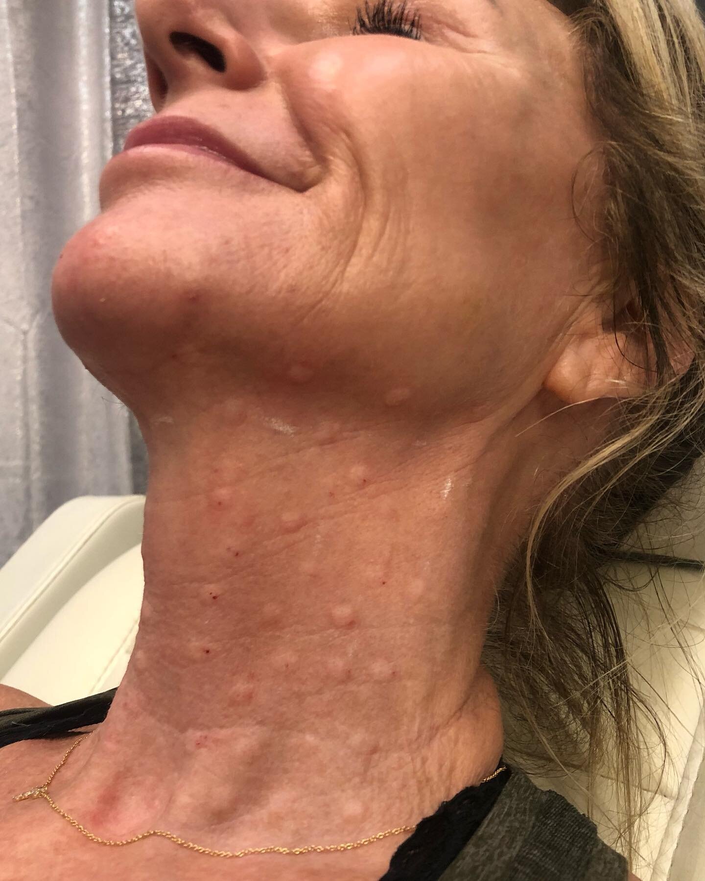 The neck can be very telling when it comes to age. Say goodbye to &ldquo;tech&rdquo; neck and HELLO to reduced lines and wrinkles with MicroTox! 

Micro doses of Botox are delivered beneath the skin to improve the skin&rsquo;s texture, laxity &amp; t