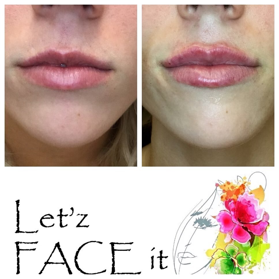 &ldquo;Goodness is beauty in the best estate.&rdquo; -Christopher Marlowe

We love these beautiful lips! Enhanced in time for the holidays.. appointments available! 

.
.
💃 procedure: non-surgically enhancement with hyaluronic acid gel to increase v